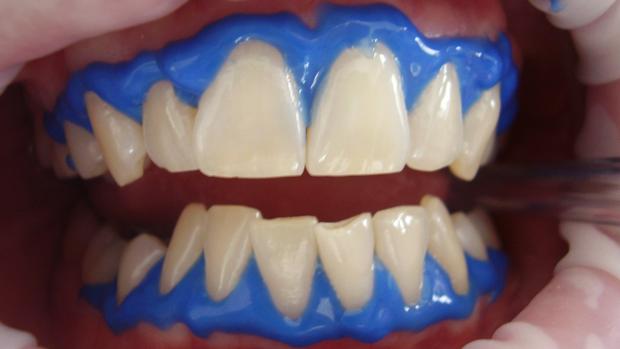 Blanqueamiento dental