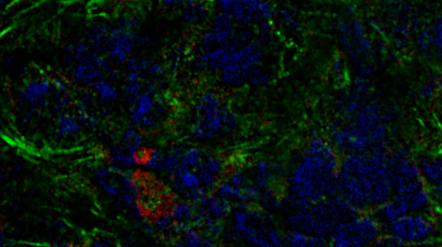 Un tumor mamario de ratón contiene fibroblastos derivados de la médula ósea (rojo), así como otros fibroblastos asociados con el cáncer (verde).