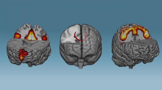 Las redes neuronales que mostraron una mayor conectividad después de una hora de entrenamiento neurofeedback: redes en modo predeterminado (izquierda), cuerpo calloso (medio) y redes sensoriomotoras (derecha).