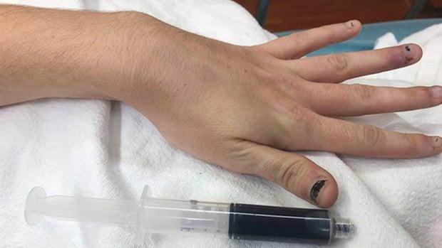 Caso de metahemoglobinemia en una joven de 25 años