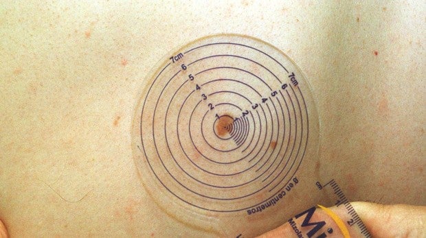 Medición médica de las dimensiones de un lunar